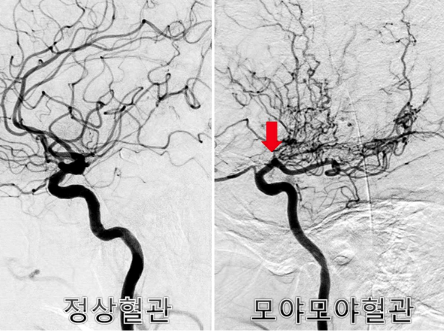 💬 &ldquo;모야모야병 그게 뭐야&rdquo; &ndash; 처음 듣는 분들을 위한 쉽고 진짜같은 설명