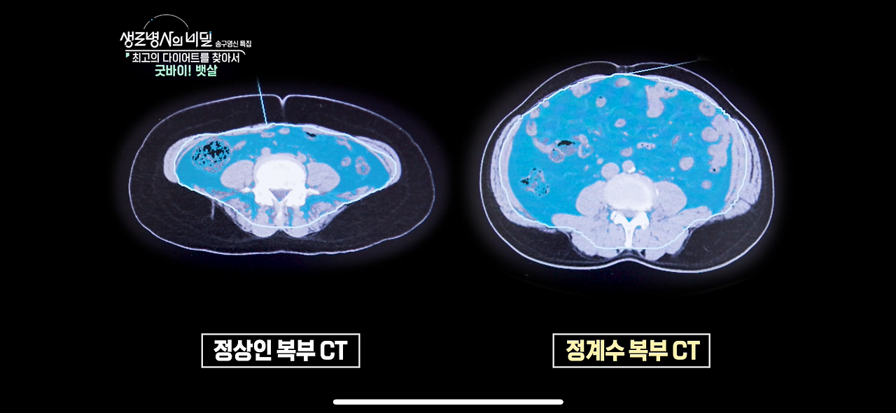 생로병사의 비밀 다이어트 굿바이 뱃살