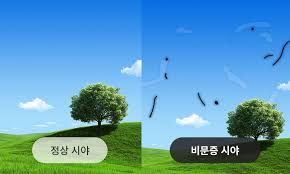 비문증 