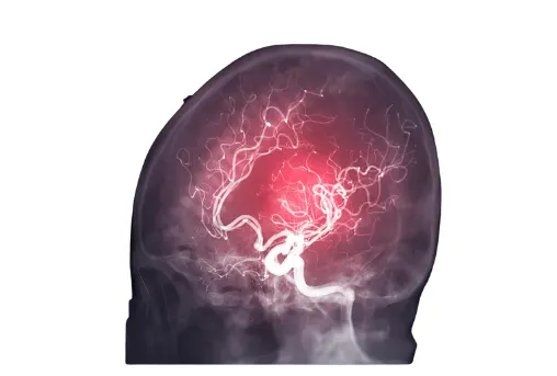 뇌경색 전조증상 및 치료 방법&amp;#44; 좋은 음식 알아보기