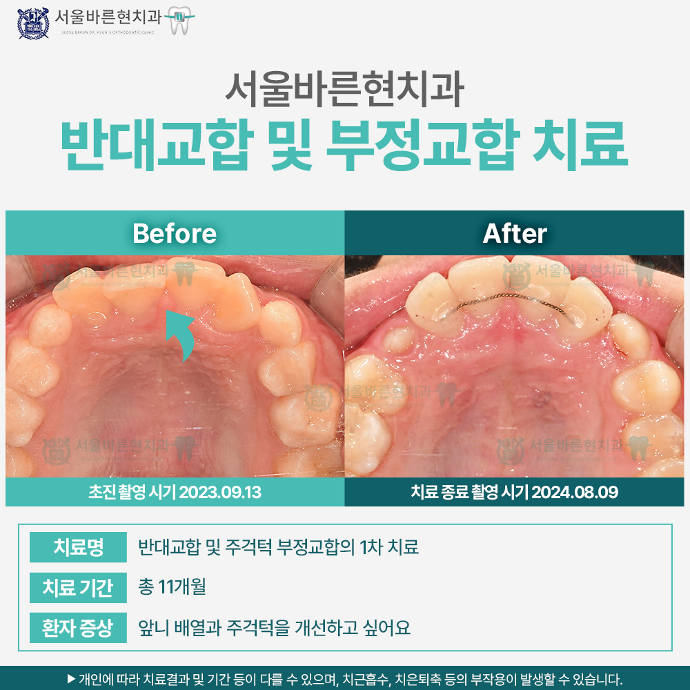 부산치아교정