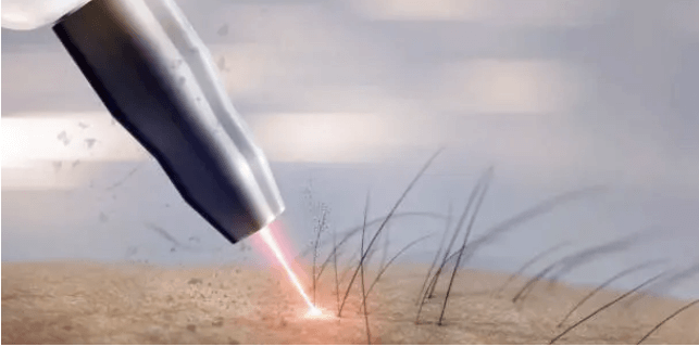 레이저제모와 왁싱 어떤게 좋을까? 브라질리언과 비키니라인 레이저제모 추천