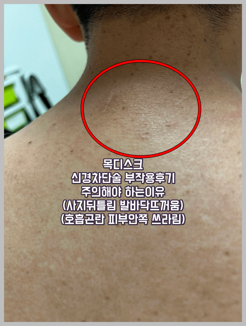 목디스크 차단술 주사 위치