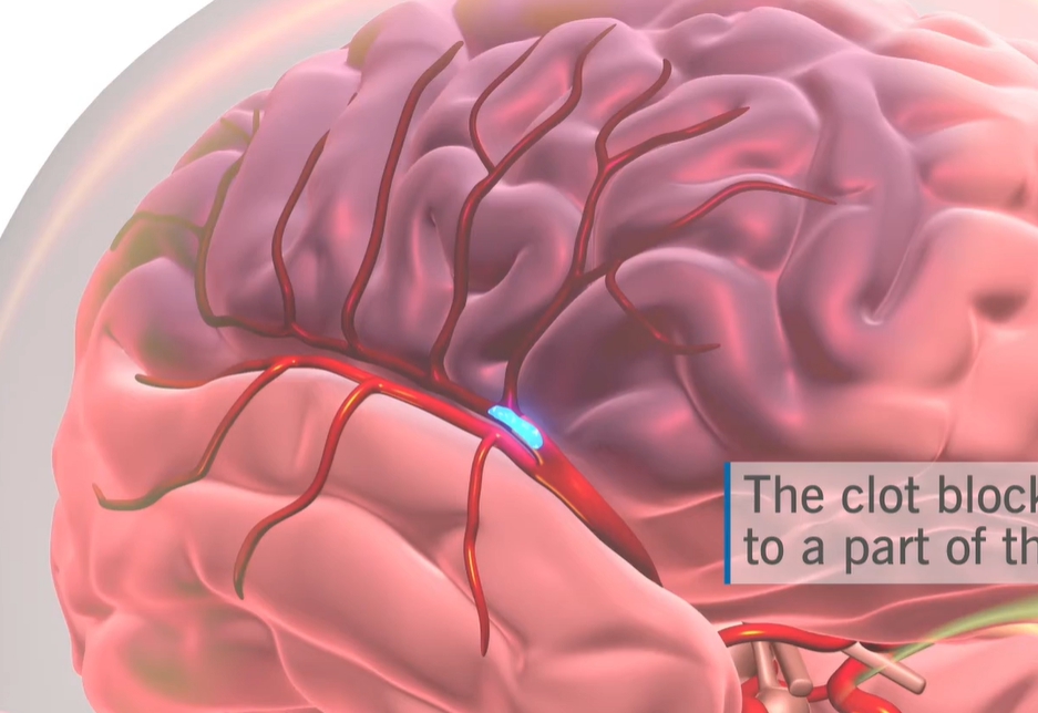 뇌경색 전조증상