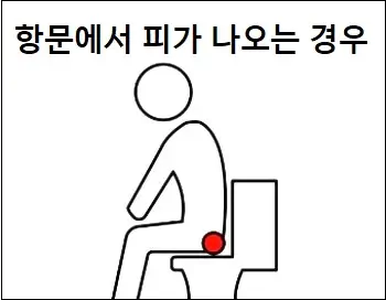 항문에서 피가 나오는 경우