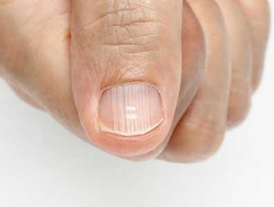 손톱에-세로줄이-생기는-이유-영양-결핍