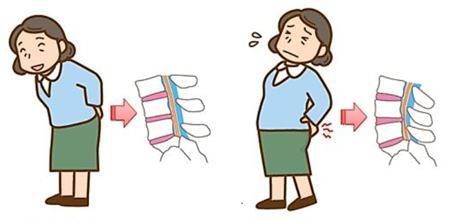 허리를-뒤로젖히는-행동은-척추협착증-통증이-심해집니다