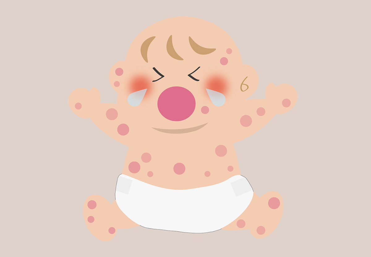 수두에-걸린-아기