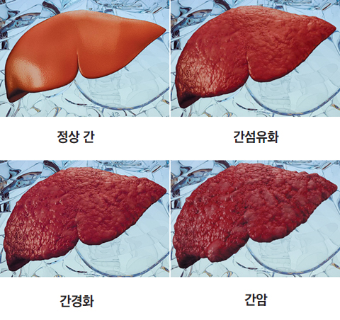 간지수 ALT AST 차이