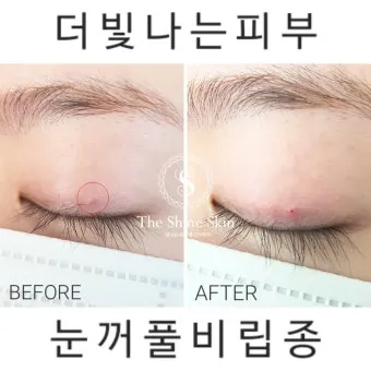 비립종 생기는 이유 비립종 없애는 방법 피부 관리법_9