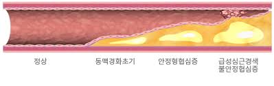 동맥경화 심장건강
