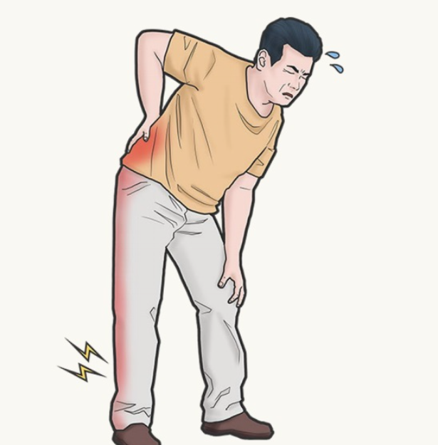 좌골신경통의 증상