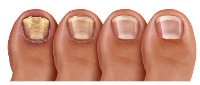 발톱무좀 약 추천 라셀턴