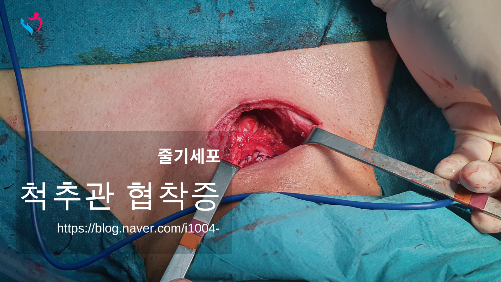 척추관 협착증 으로 인한 하지 근력 저하란?