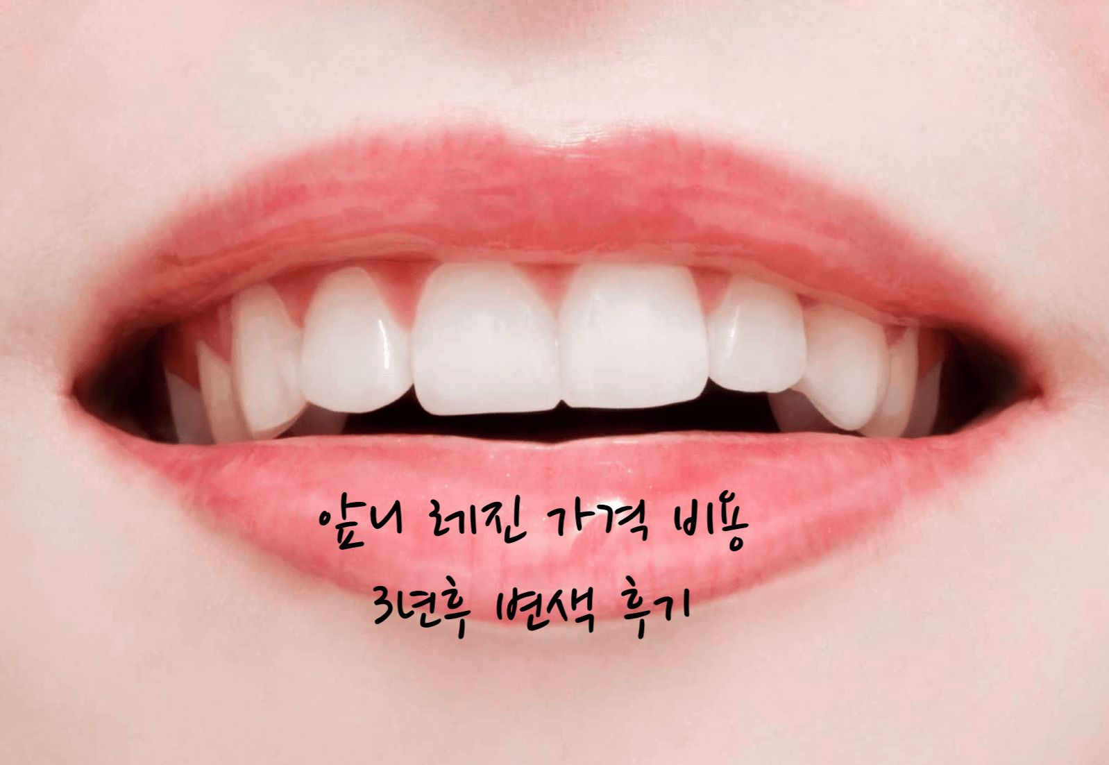 앞니 레진 가격