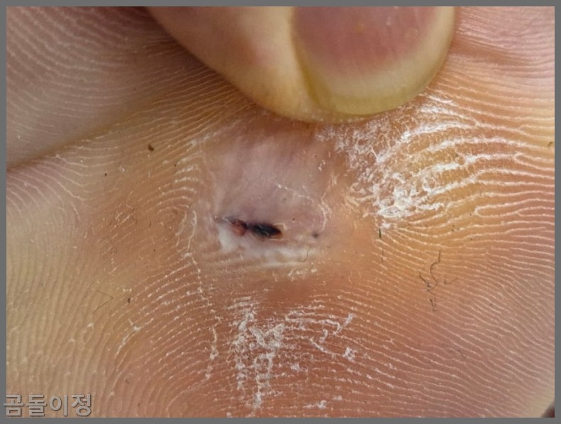 발바닥 티눈 치료법부터 재발 방지까지, 실제 후기로 정리한 팁