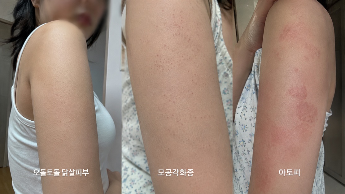 오돌토돌 닭살피부와 모공각화증, 아토피 피부 증상 차이를 팔 피부로 비교한 사진