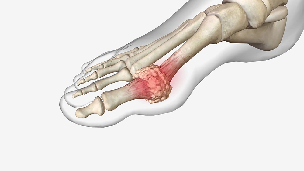 통풍에 해로운 음식