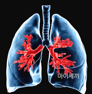 폐렴 증상