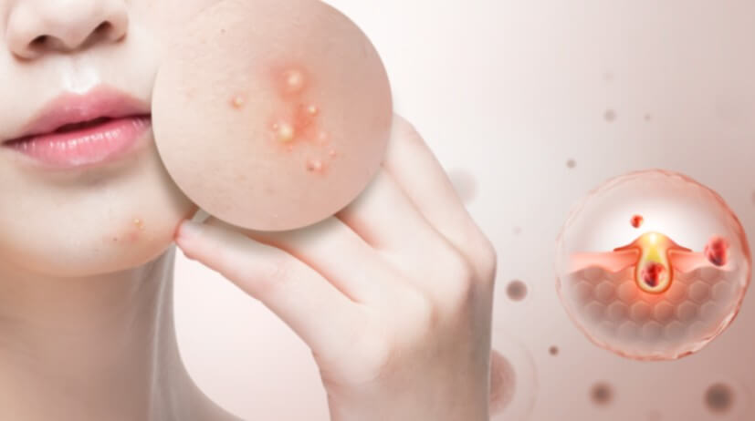 화농성 여드름 증상