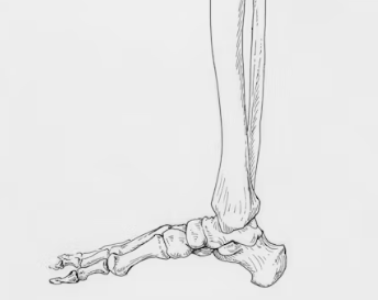통풍 치료법 진단 기준 합병증