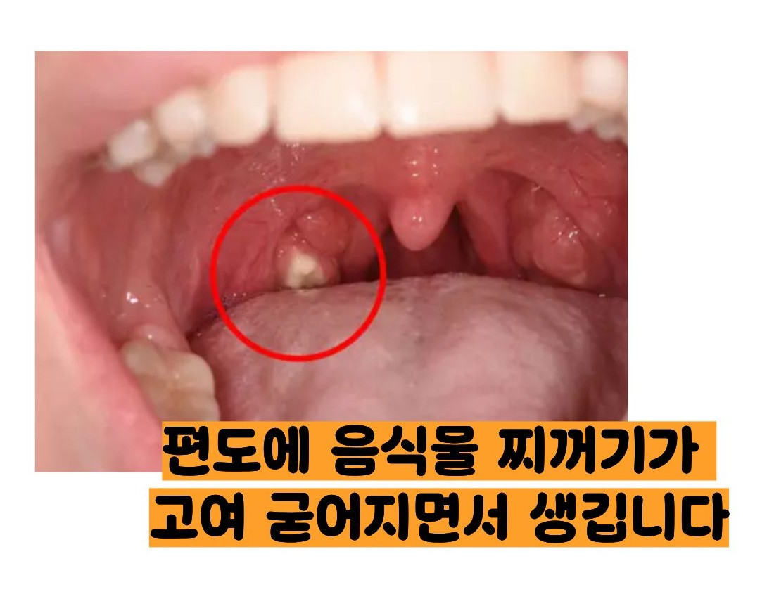 편도결석 원인