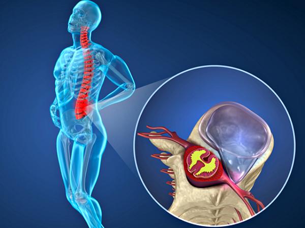 허리디스크에 좋은 운동