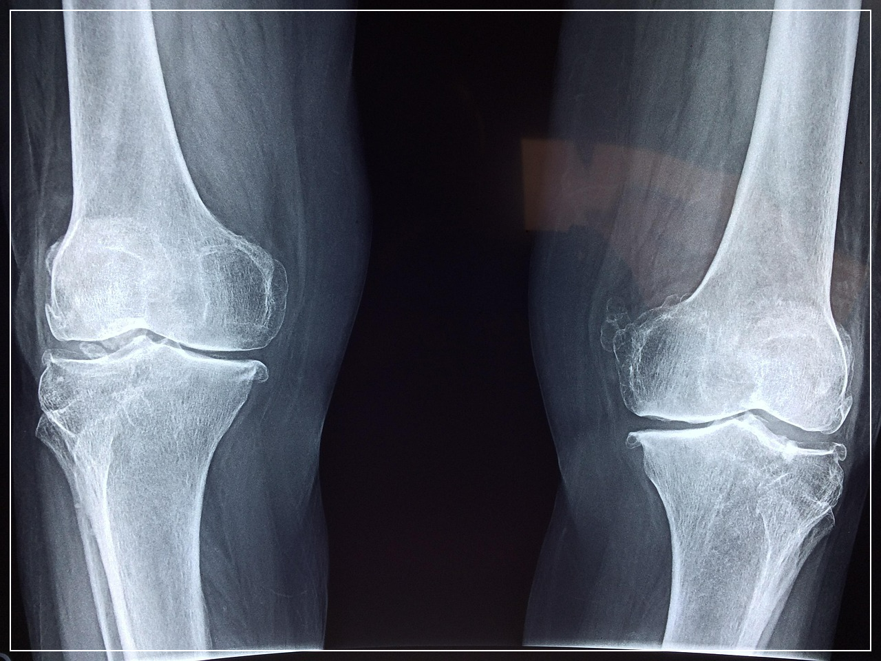 중년의 관절, 왜 더 뻣뻣하고 아픈가요?