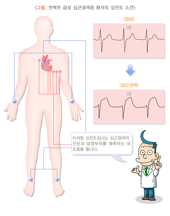 심근경색 검사방법