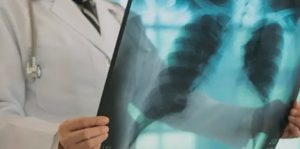 결핵 관련 사진