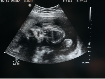 태아보험 100세 만기 vs 30세 만기 비교 가입 전 필독 가이드