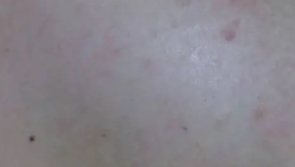 피부 붉은반점 25