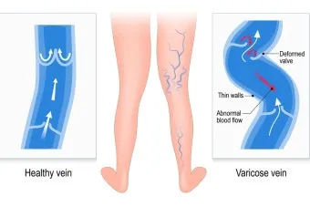 하지 정맥류 증상 치료방법과 예방 생활습관_15