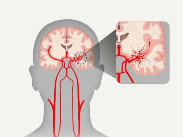 모야모야병 증상 및 원인과 장애등급 여부 알아보기