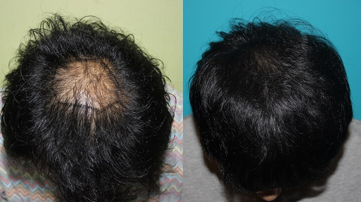 정수리-수술전후
