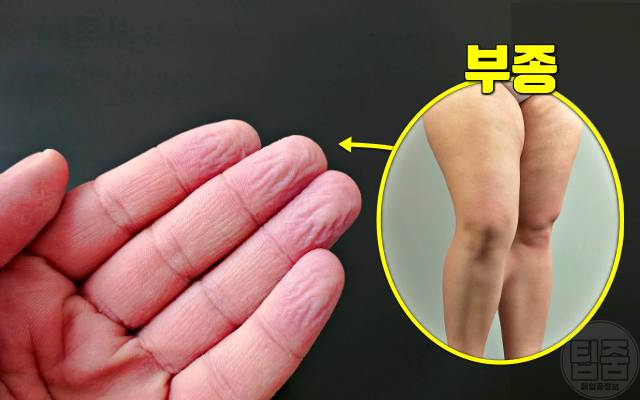 손가락 주름 병 질환 림프부종