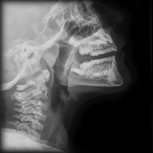 hypopharyngeal dilatation