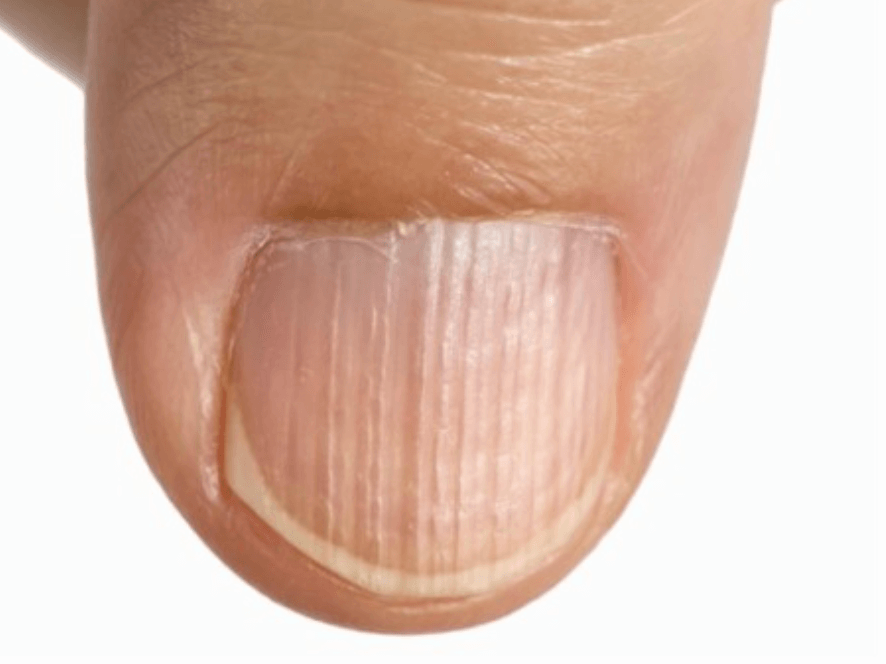 손톱 흰색 세로줄