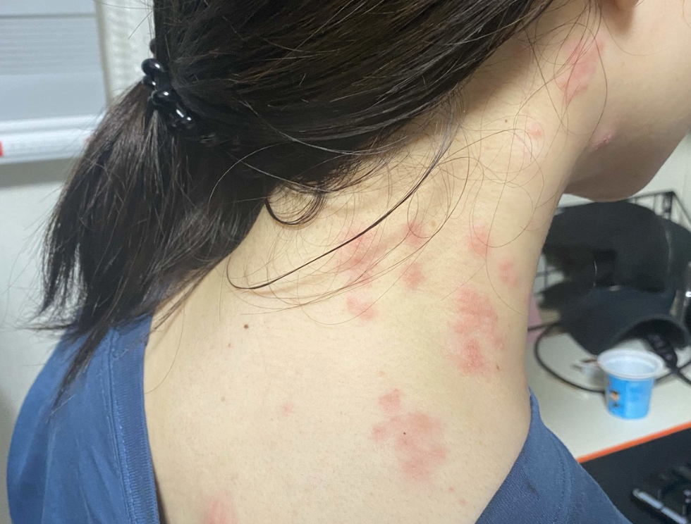 대상포진