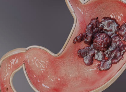 역류성식도염 증상 자연치료 방법 좋은 음식 등 총정리(2024 최신)