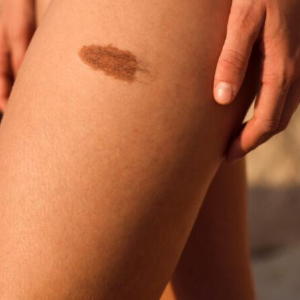 신경섬유종 초기 증상, 혹시 나도? 놓치면 안 되는 신호