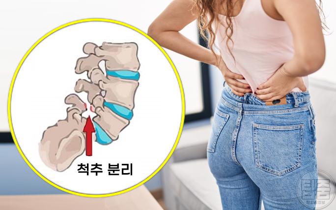 허리가 찌릿 아플때 척추관협착증 증상 원인 척추분리증