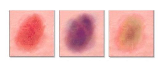 몸에 멍이 잘드는 이유