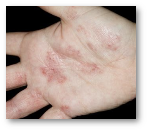 손 습진2