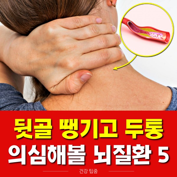 뒷골이 땡기면서 머리가 아파요 뒷목이 뻐근한 증상 뇌동맥류 파열 지주막하출혈, 건강 팁줌 매일꿀정보