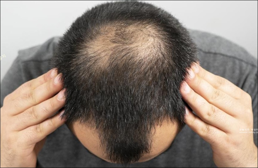 m자 정수리 탈모