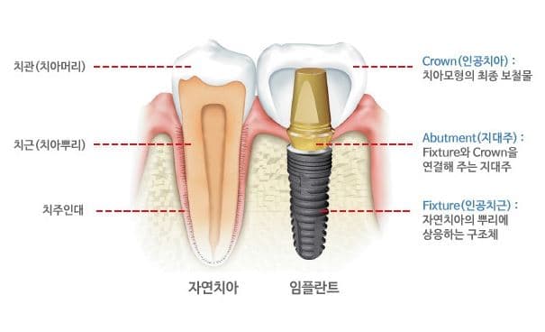 임플란트 시술과정