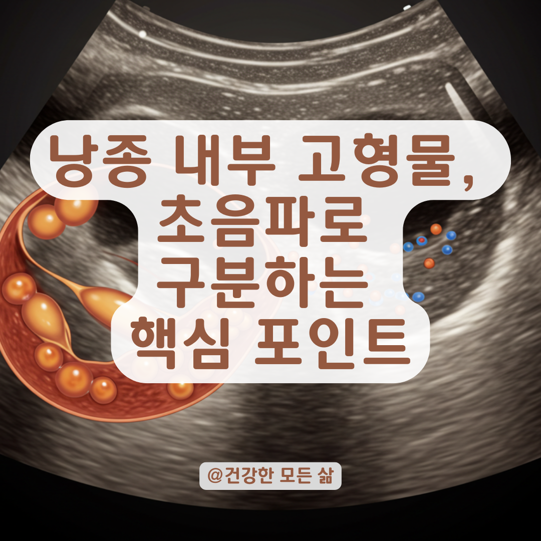 낭종 내부 고형물, 단순 낭종과 난소암을 구분하는 핵심 소견 알아보기.