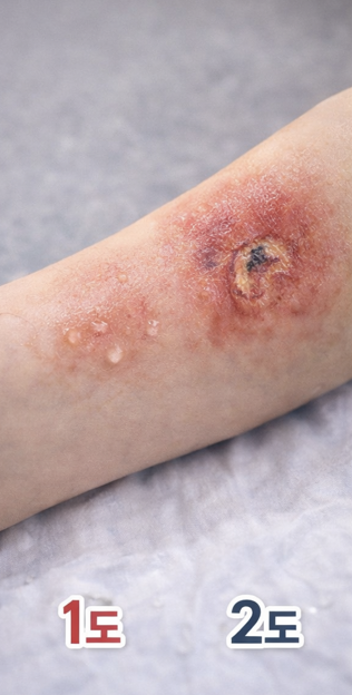 화상 단계별 증상 이해하기 관련 사진