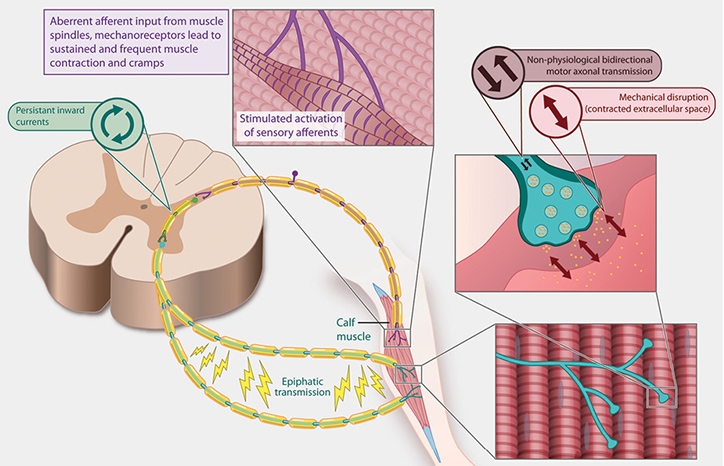 종아리 근육 뭉침